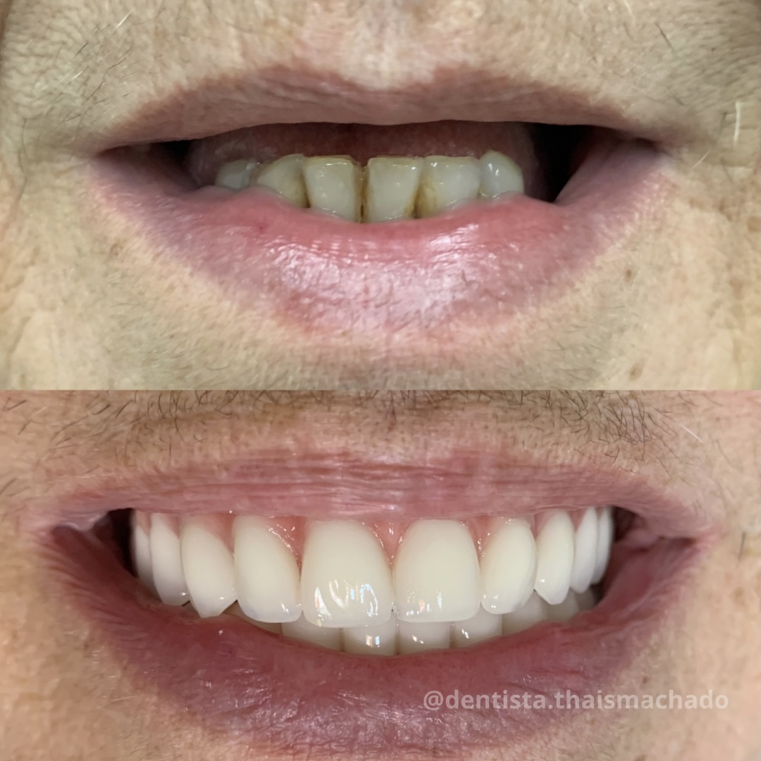 Caso clínico 2 antes e depois